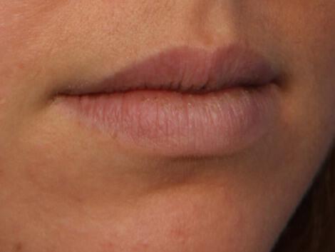 Injectable Fillers Gallery Before & After Image