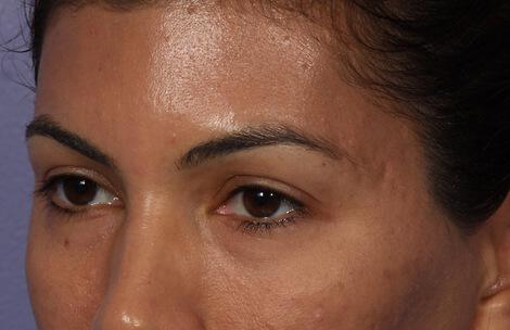 Injectable Fillers Gallery Before & After Image