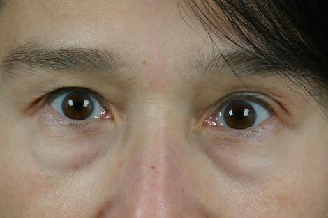 Injectable Fillers Gallery Before & After Image