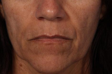 Injectable Fillers Gallery Before & After Image