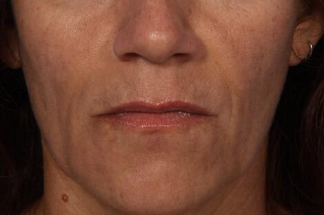 Injectable Fillers Gallery Before & After Image