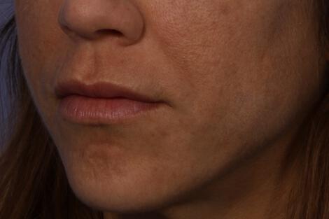 Injectable Fillers Gallery Before & After Image