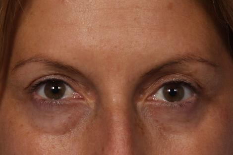 Injectable Fillers Gallery Before & After Image