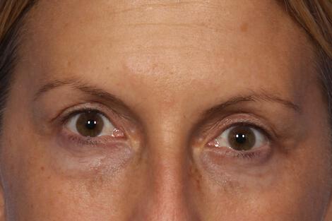 Injectable Fillers Gallery Before & After Image