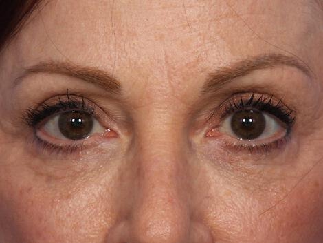 Injectable Fillers Gallery Before & After Image