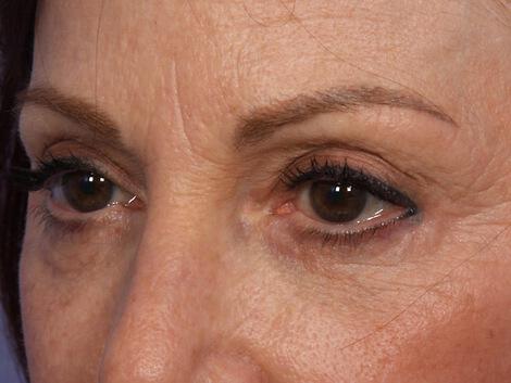 Injectable Fillers Gallery Before & After Image