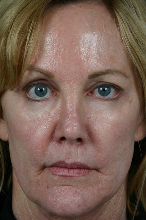 Injectable Fillers Gallery Before & After Image