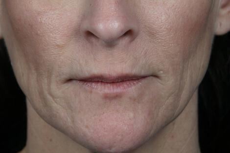 Injectable Fillers Gallery Before & After Image