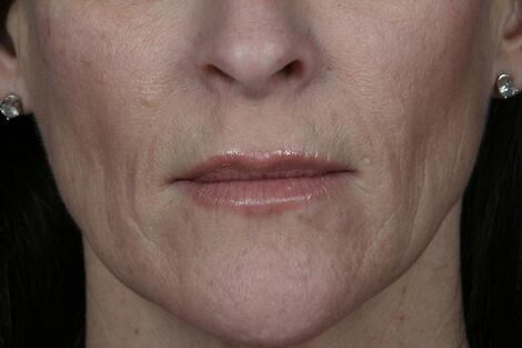 Injectable Fillers Gallery Before & After Image