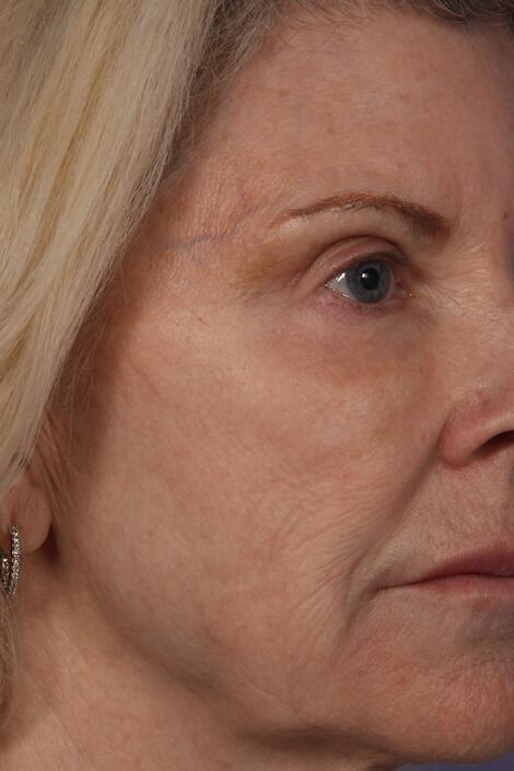 Injectable Fillers Gallery Before & After Image