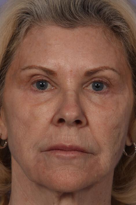 Injectable Fillers Gallery Before & After Image