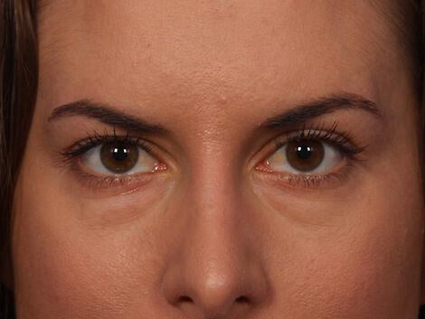 Injectable Fillers Gallery Before & After Image