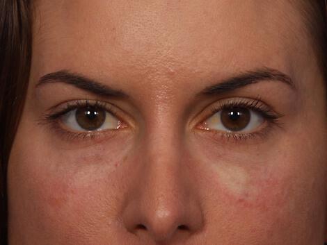 Injectable Fillers Gallery Before & After Image