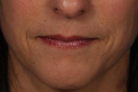 Injectable Fillers Gallery Before & After Image