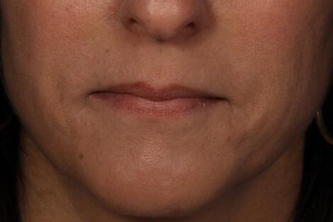 Injectable Fillers Gallery Before & After Image