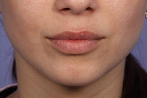 Injectable Fillers Gallery Before & After Image