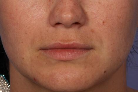 Injectable Fillers Gallery Before & After Image