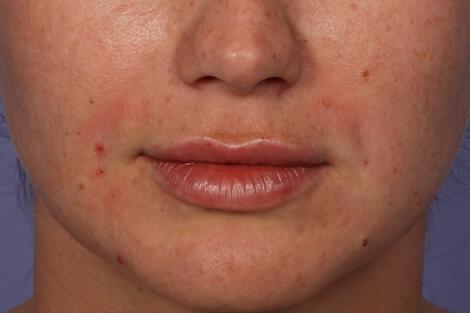Injectable Fillers Gallery Before & After Image