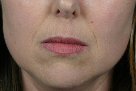 Injectable Fillers Gallery Before & After Image