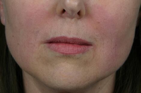 Injectable Fillers Gallery Before & After Image