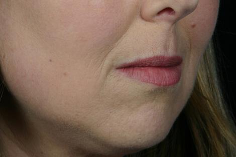 Injectable Fillers Gallery Before & After Image