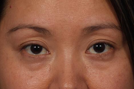 Injectable Fillers Gallery Before & After Image