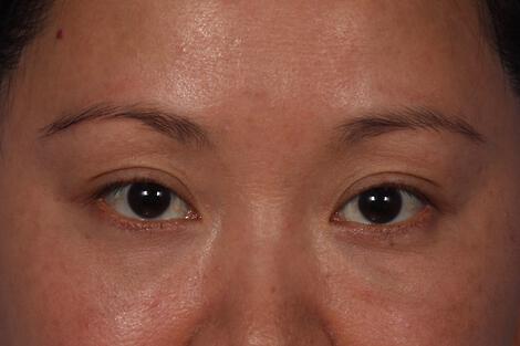 Injectable Fillers Gallery Before & After Image