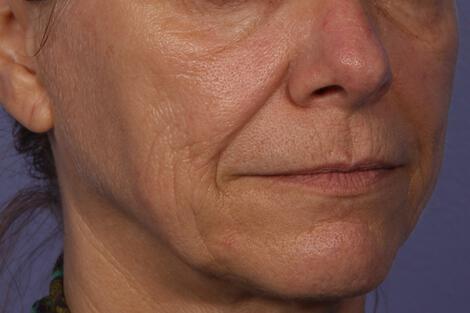 Sculptra Gallery Before & After Image