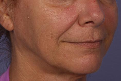 Sculptra Gallery Before & After Image