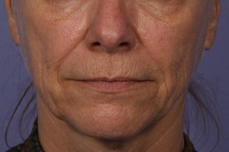 Sculptra Gallery Before & After Image