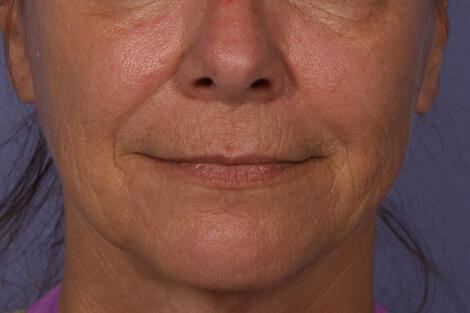 Sculptra Gallery Before & After Image