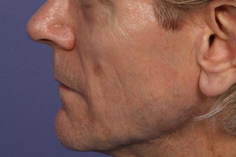 Sculptra Gallery Before & After Image