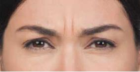 Wrinkle Reduction Gallery Before & After Image