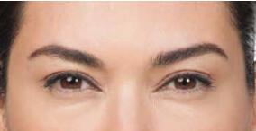 Wrinkle Reduction Gallery Before & After Image