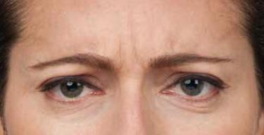 Wrinkle Reduction Gallery Before & After Image