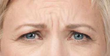 Wrinkle Reduction Gallery Before & After Image