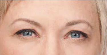 Wrinkle Reduction Gallery Before & After Image