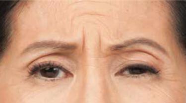 Wrinkle Reduction Gallery Before & After Image