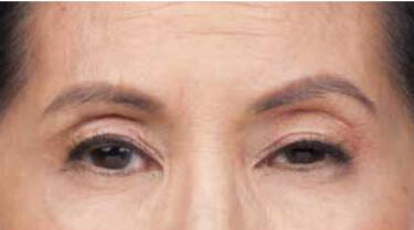 Wrinkle Reduction Gallery Before & After Image