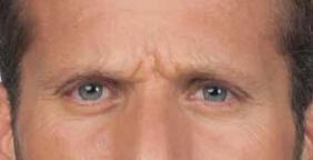 Wrinkle Reduction Gallery Before & After Image