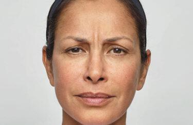 Wrinkle Reduction Gallery Before & After Image