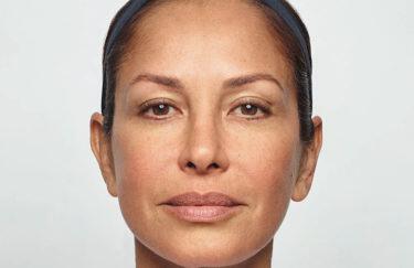 Wrinkle Reduction Gallery Before & After Image