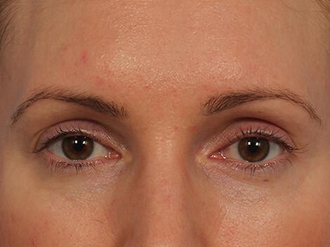 Wrinkle Reduction Gallery Before & After Image