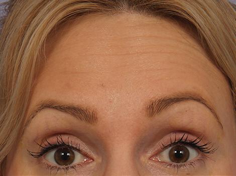 Wrinkle Reduction Gallery Before & After Image