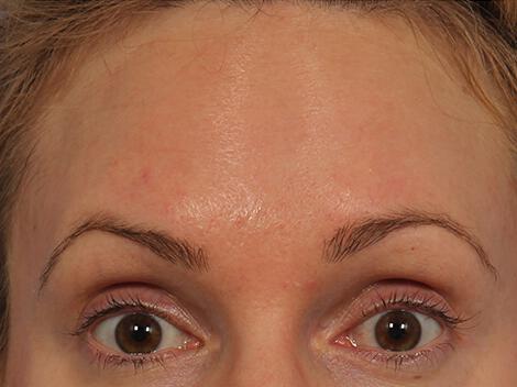 Wrinkle Reduction Gallery Before & After Image