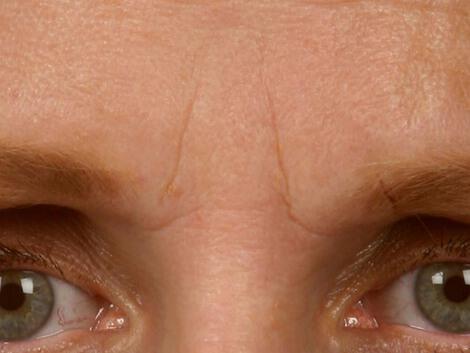 Wrinkle Reduction Gallery Before & After Image