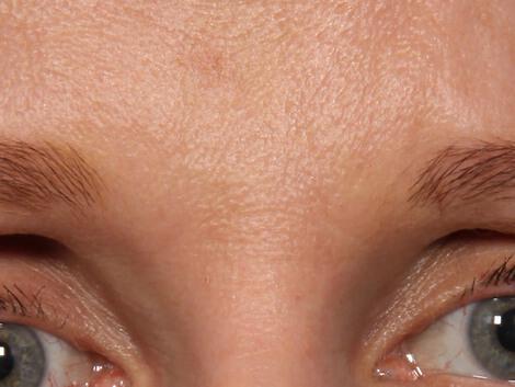 Wrinkle Reduction Gallery Before & After Image