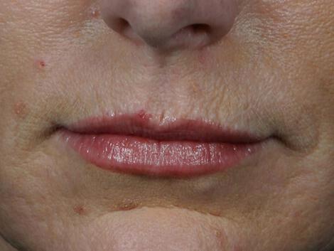 Wrinkle Reduction Gallery Before & After Image