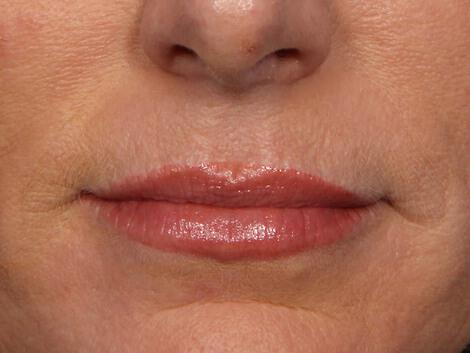 Wrinkle Reduction Gallery Before & After Image