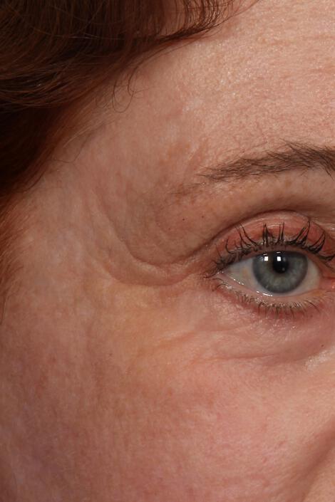 Wrinkle Reduction Gallery Before & After Image